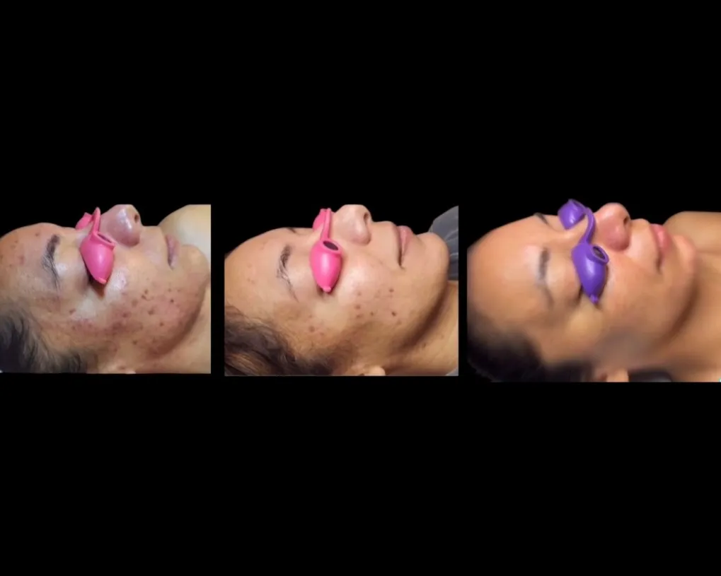 Almost a decade ago I got certified as an acne specialist. Having personally dealt with fluctuating hormonal acne in my