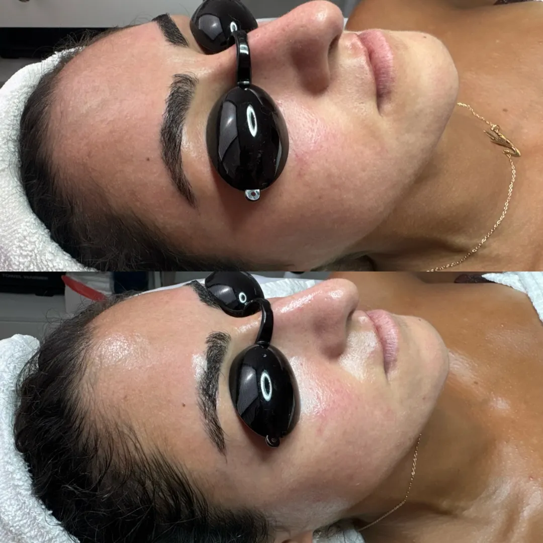 ☝️ Treatment BEFORE & AFTER
.
Keeping it simple with Microdermabrasion & Oxi Trio by PCA. This is one of my go to’s to