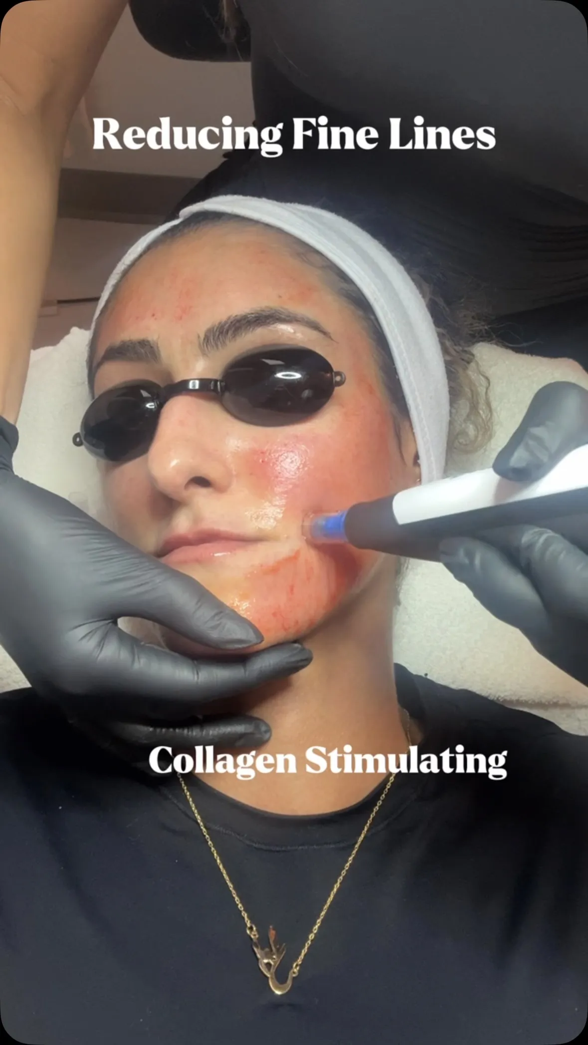 Microneedling ASMR- the sound of increasing your collagen by 400% after a series of 3.
.
My favorite treatment to do- @d